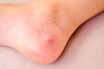 Managing Blisters on the Legs and Feet
