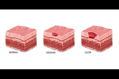 Understanding Pressure Ulcers on the Legs and Feet