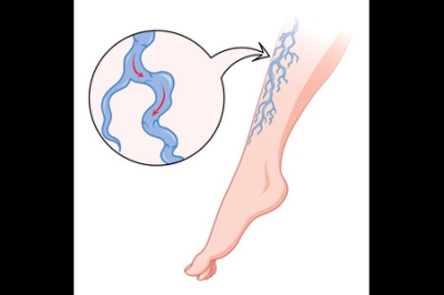 Healing Stubborn Leg Sores Caused by Poor Circulation