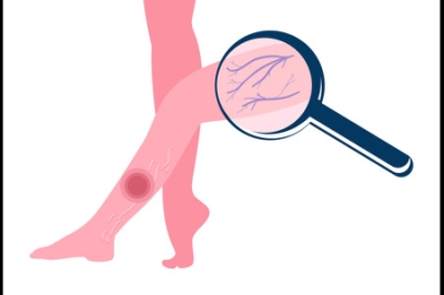 Arterial Skin Ulcers on the Lower Legs and Feet