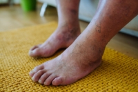 Understanding and Managing Diabetic Foot Problems