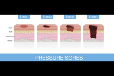 Pressure Sores on the Lower Extremities